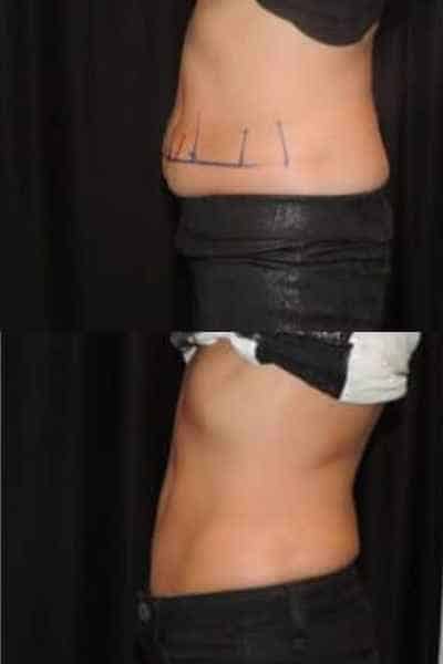 HIEMT Muscle Toning Surrey