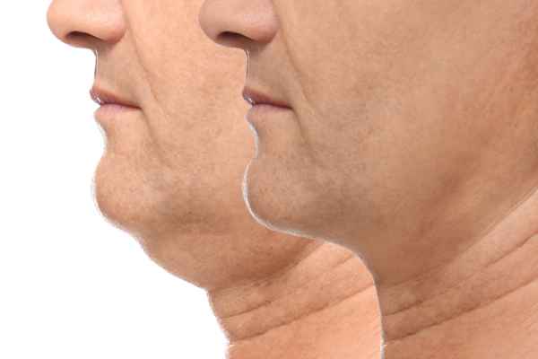 HIFU - Breakthrough in Anti - ageing 2 hifu results Surrey