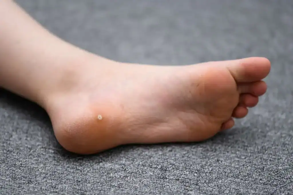 Cryotherapy For Warts And Also Verrucas 2 Image of verruca on the bottom of the foot that able to be treated with Cryotherapy Surrey