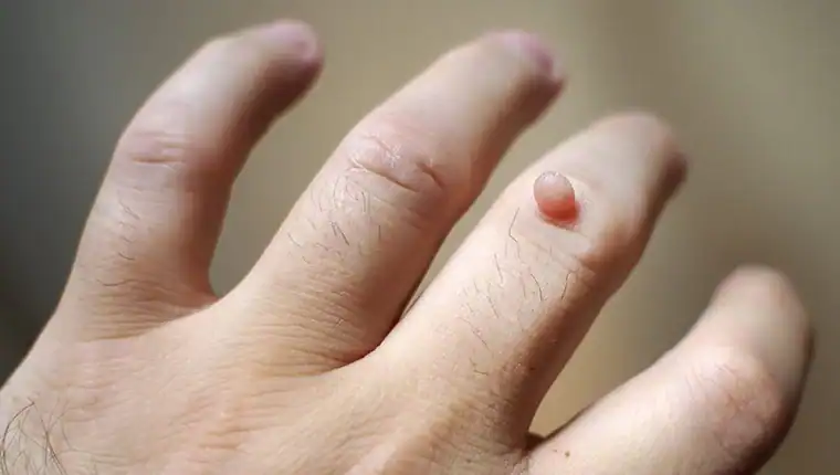 Image of blemish that Cryotherapy Surrey can remove with Lipo 360.