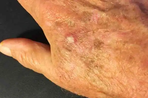 Cryopen For Actinic Keratoses 1 Image of Actinic keratoses Surrey on a person hand