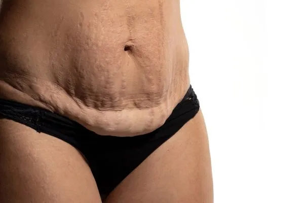 The Science of Skin Tightening 1 The science behind skin tightening Surrey picture of a woman's sagging skin on the stomach